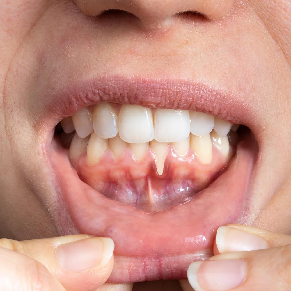 Close-up of inflamed gums showing early signs of gingivitis