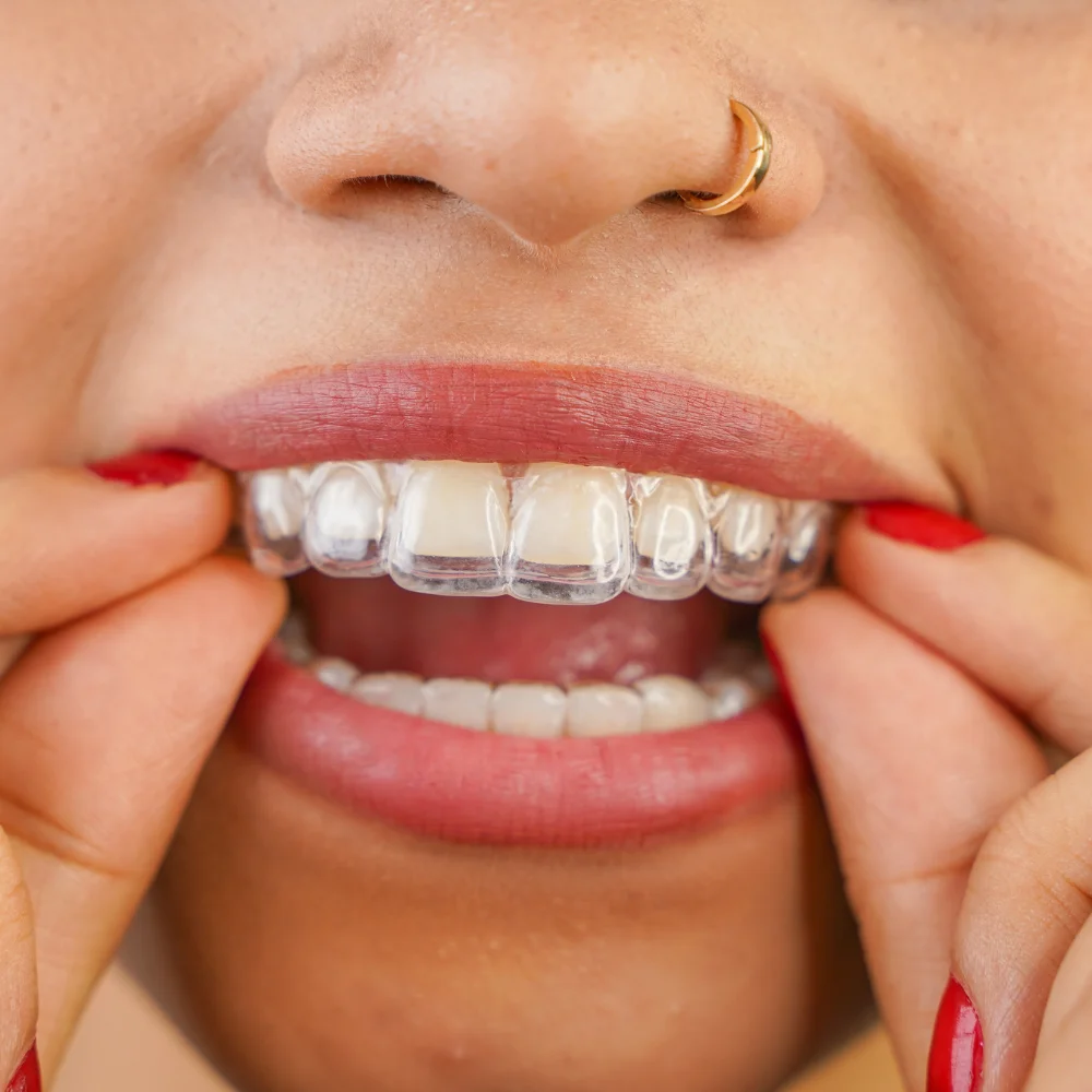 Patient wearing clear aligner during orthodontic treatment – Hanlon Creek Dental, Guelph ON