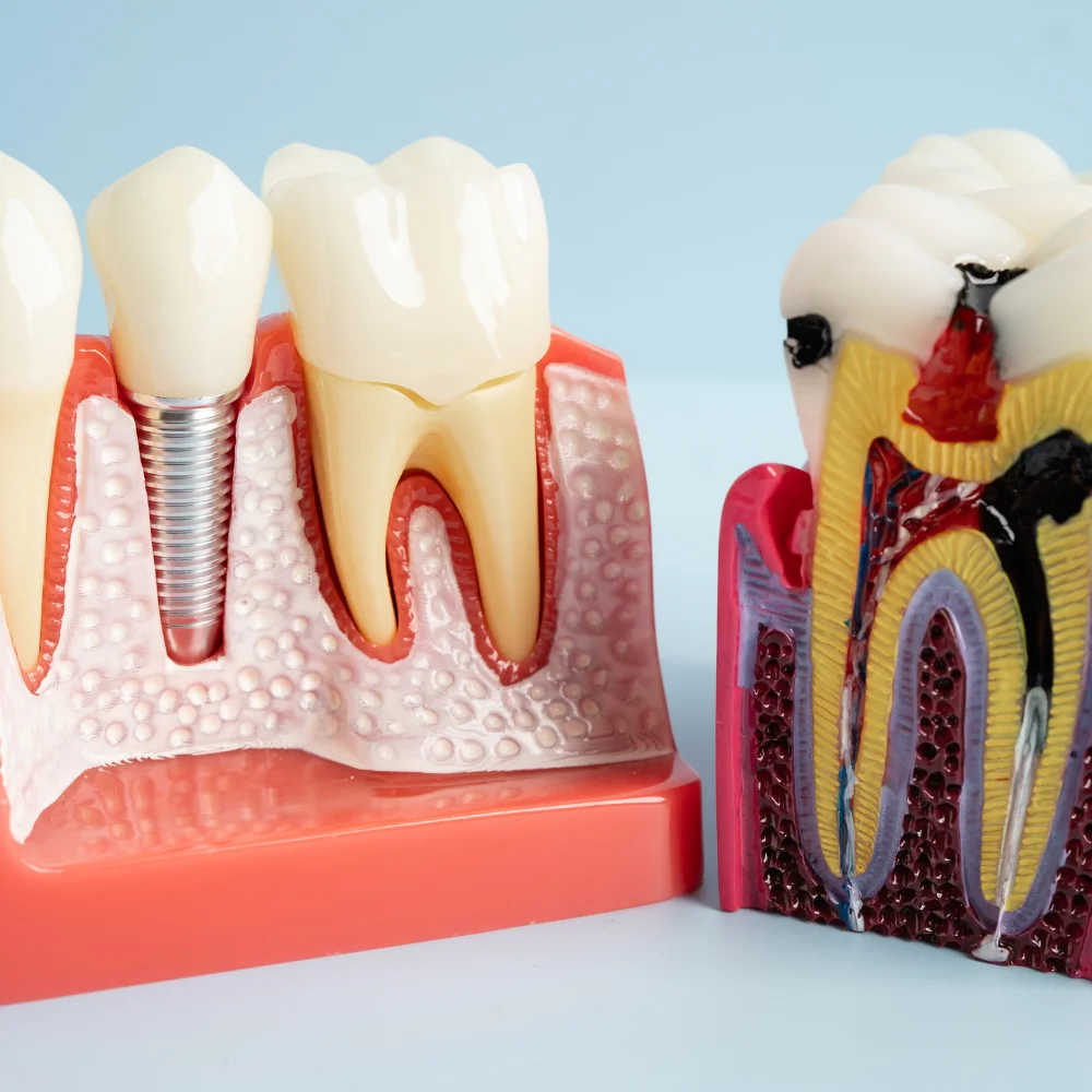 Cross-section model showing comparison between a dental implant and a natural tooth with infected pulp used to explain root canal and implant treatment options at Hanlon Creek Dental, Guelph ON.