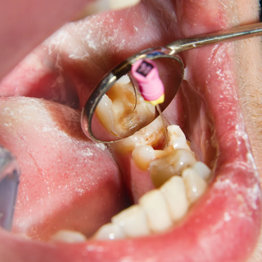 Close-up view of a dentist examining a severely decayed molar using a dental mirror during an oral cavity check at Hanlon Creek Dental, Guelph, ON.