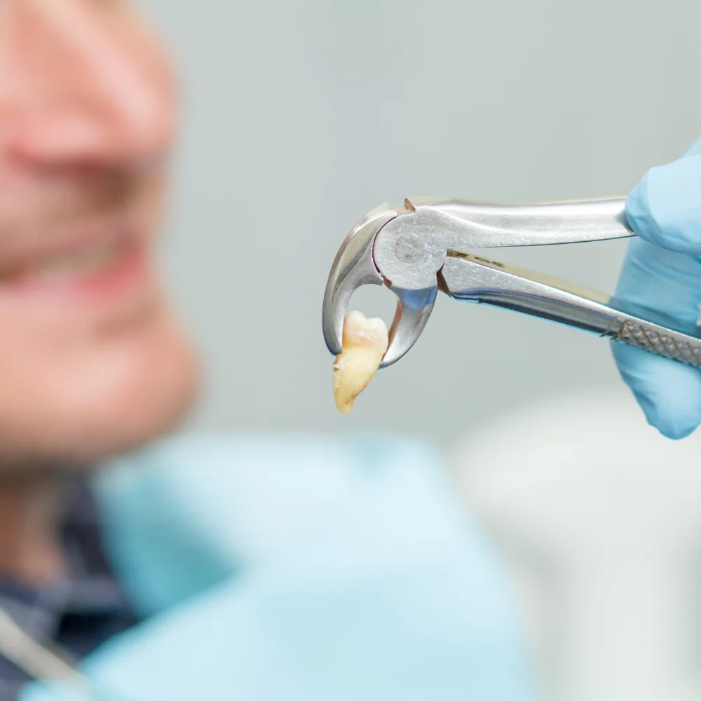 Dentist holding a freshly extracted tooth with dental forceps while a patient is seated in the dental chair at Hanlon Creek Dental in Guelph, ON.
