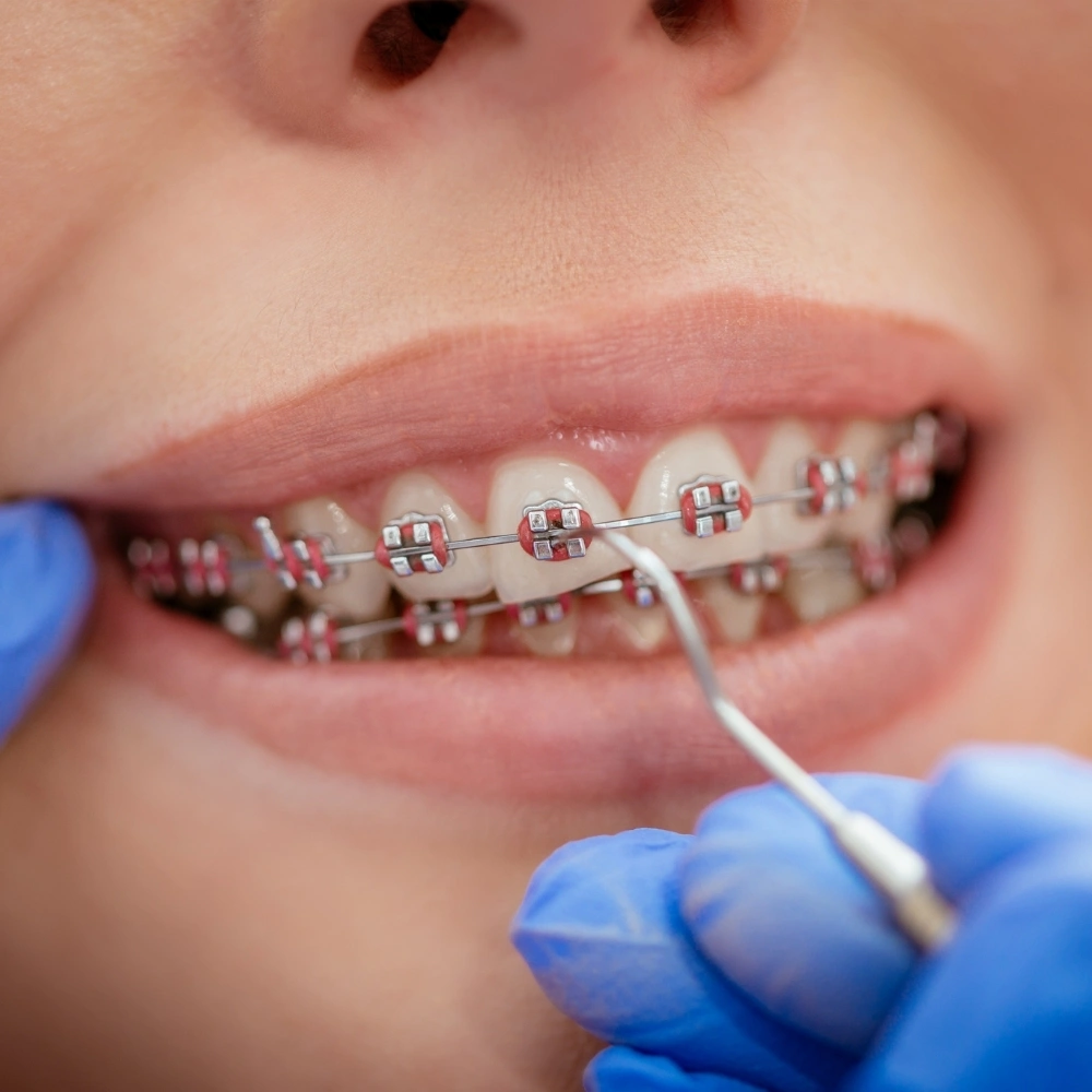 Dentist performing braces adjustment on a patient using dental tools during an orthodontic treatment at a Dentist performing braces adjustment on a patient using dental tools during an orthodontic treatment at a modern dental clinic in Guelph, ON.Dentist performing braces adjustment on a patient using dental tools during an orthodontic treatment at a modern dental clinic in Guelph, ON.Dentist performing braces adjustment on a patient using dental tools during an orthodontic treatment at a Hanlon Creek dental clinic in Guelph, ON. 