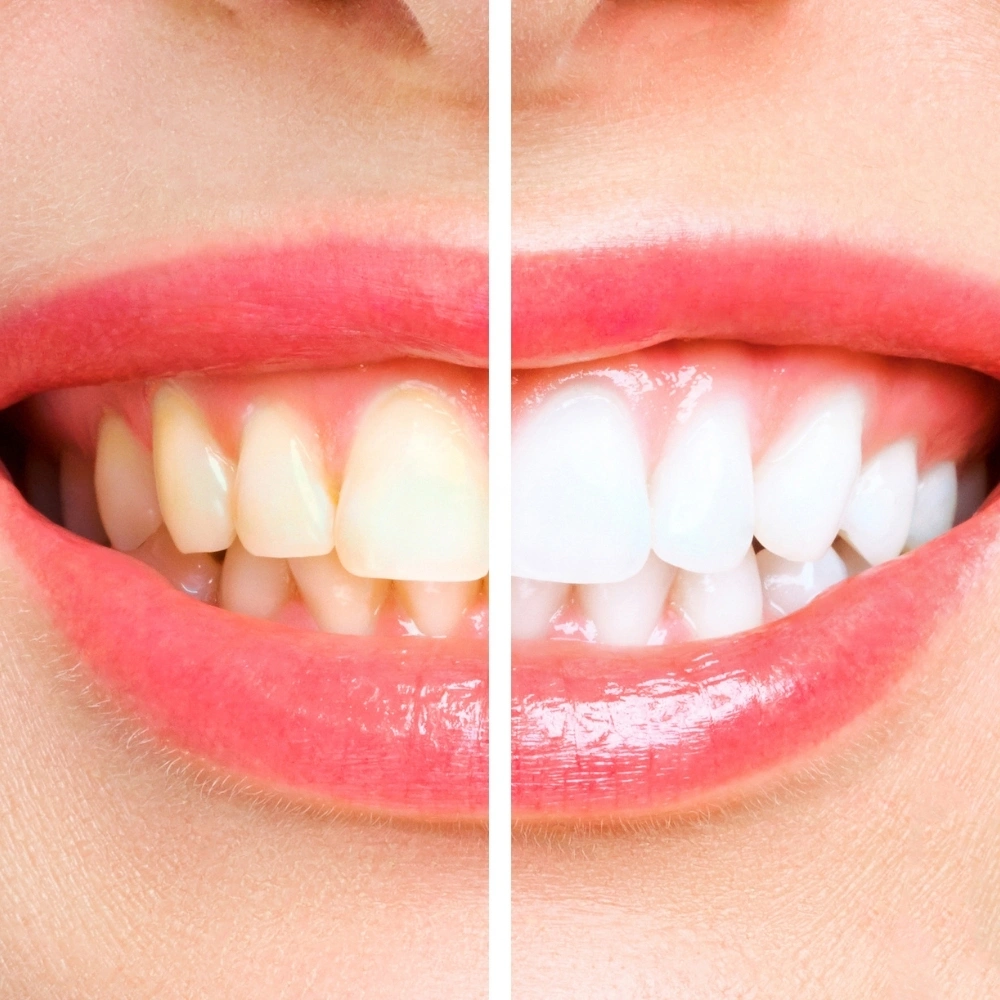 Before-and-after comparison showing a brighter smile after teeth whitening at Hanlon Creek Dental in Guelph, ON