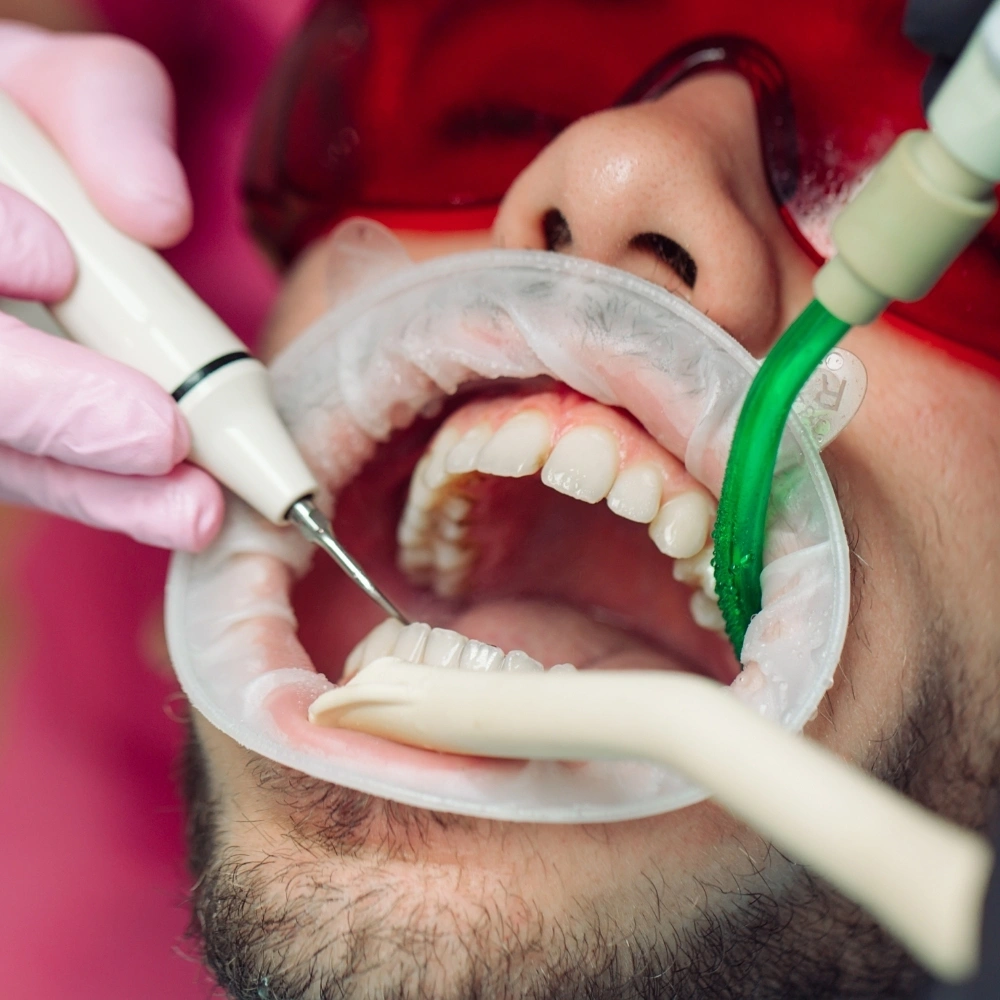 Close-up of a patient undergoing professional dental cleaning using scaling and suction tools performed by a dentist at Hanlon Creek Dental in Guelph, Ontario.