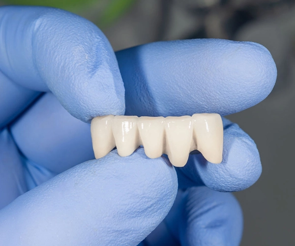 Dental professional holding a ceramic dental bridge for tooth replacement at Hanlon Creek Dental in Guelph, Ontario.