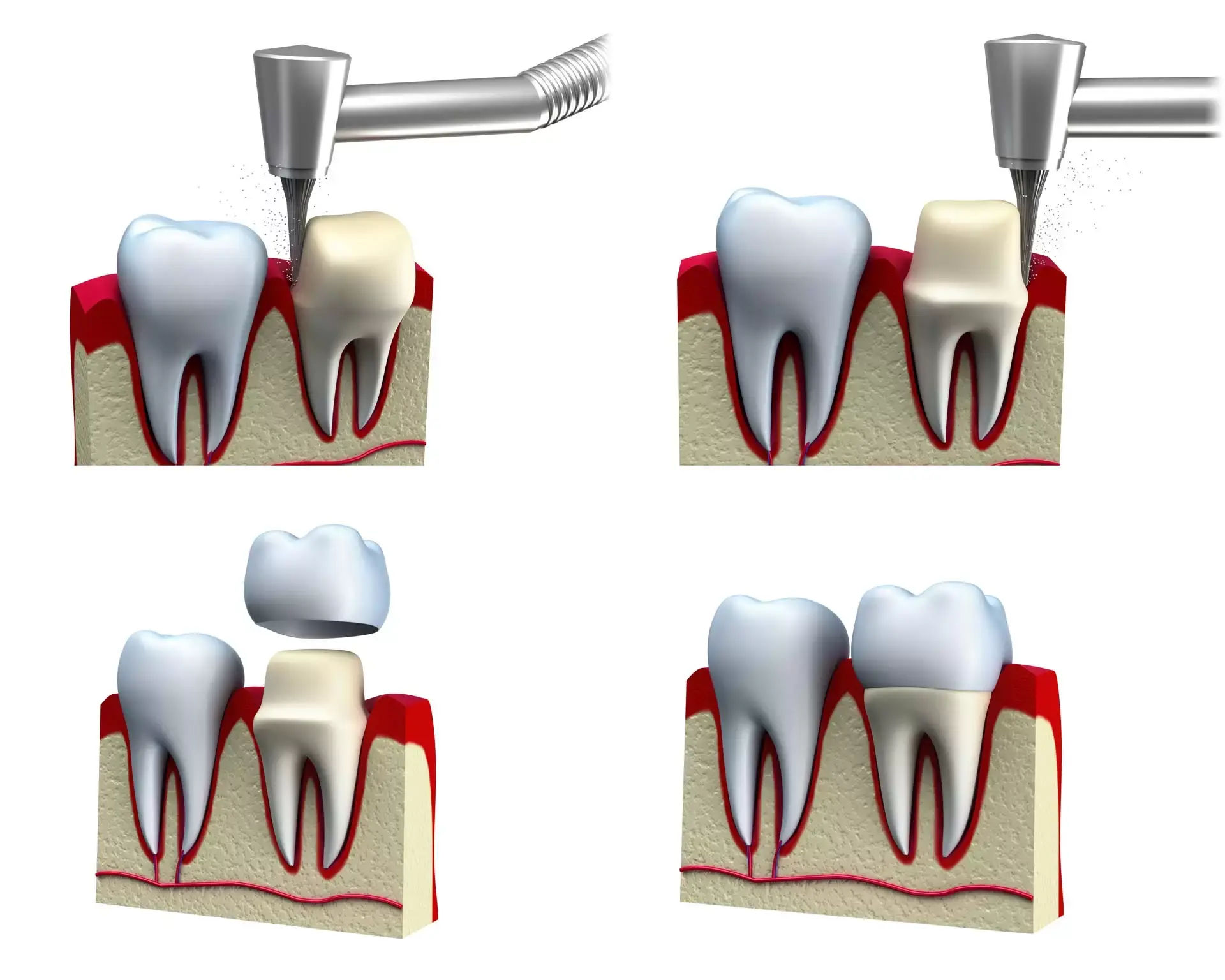 llustration detailing the three main steps of a dental crown procedure: tooth preparation, crown placement, and the final restored tooth.